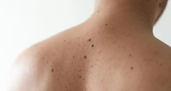 The Day Clinic - Moles