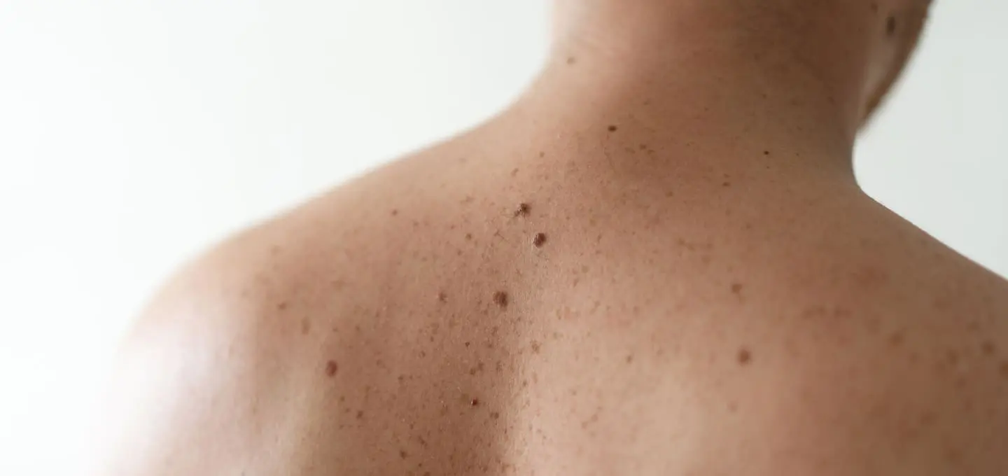The Day Clinic - Moles