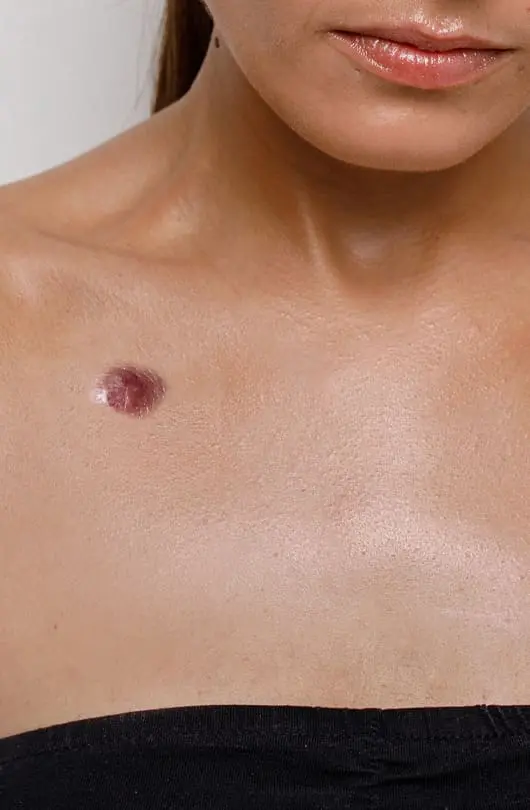 The Day Clinic - Skin Cancer