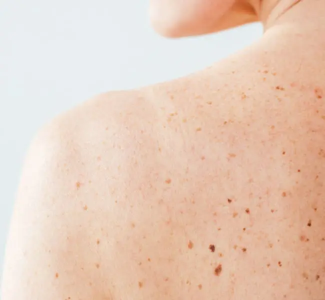 Dermatology