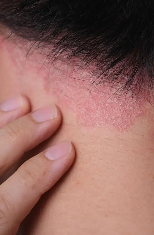 The Day Clinic - Eczema
