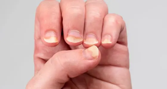 The Day Clinic - Fungal Infections