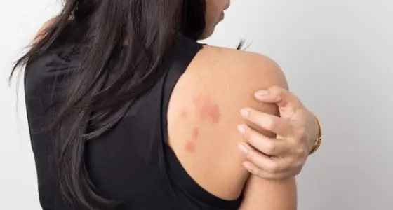 The Day Clinic - Urticaria