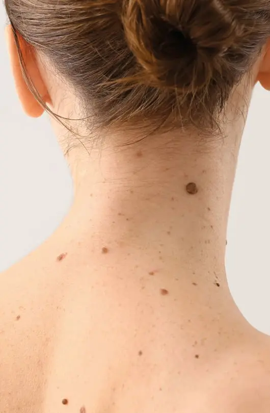 Skin Treatment at The Day Clinic