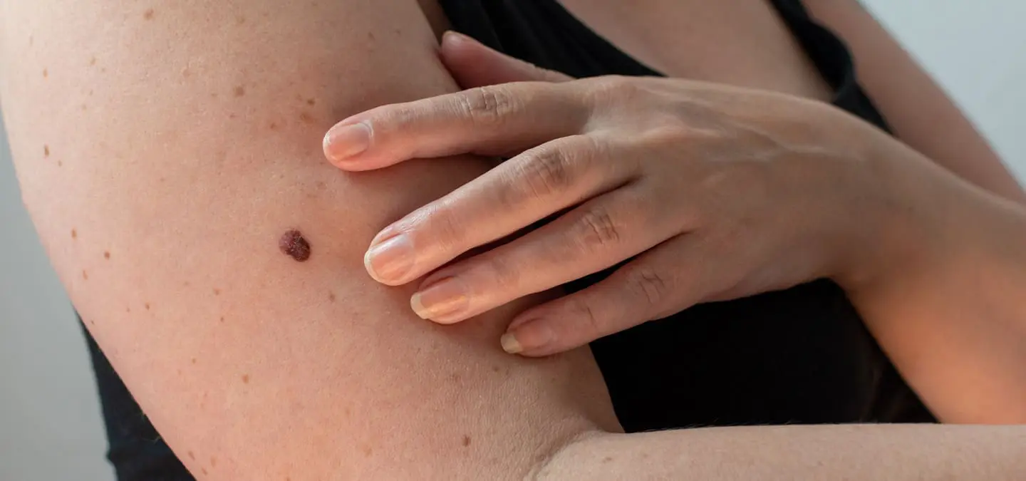 Mole Treatment - The Day Clinic