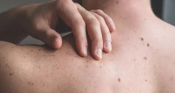 Surgical Excision Treatment - The Day Clinic