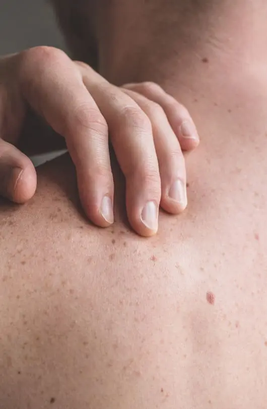 Moles On A Persons Back