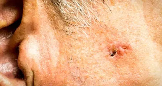 The Day Clinic - Basal Cell Carcinoma