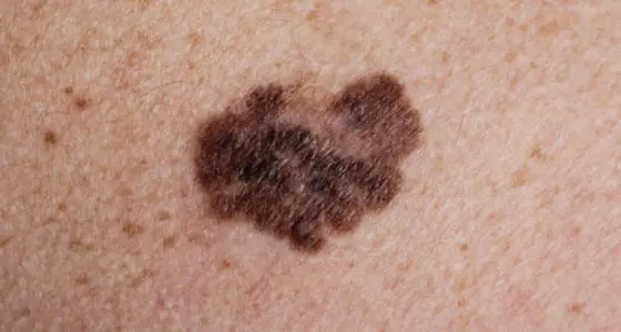The Day Clinic - Melanoma