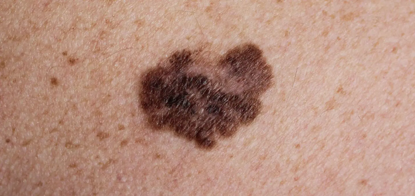 The Day Clinic - Melanoma