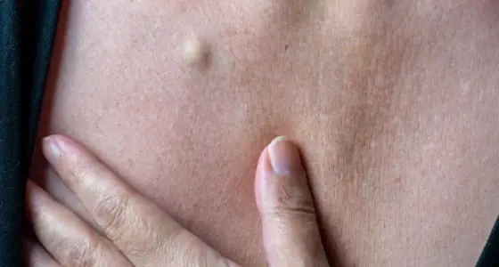 The Day Clinic - Sebaceous Cysts