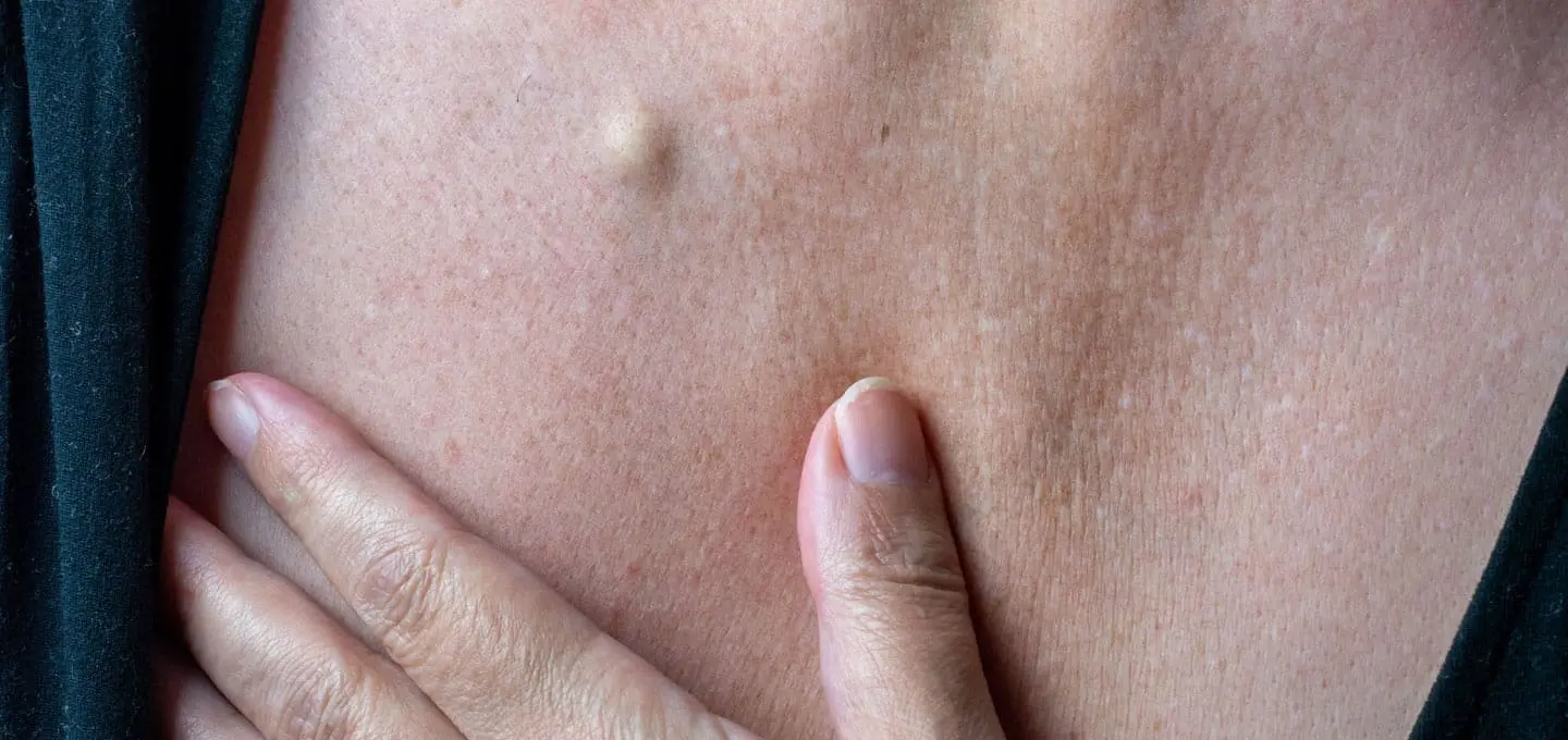 The Day Clinic - Sebaceous Cysts