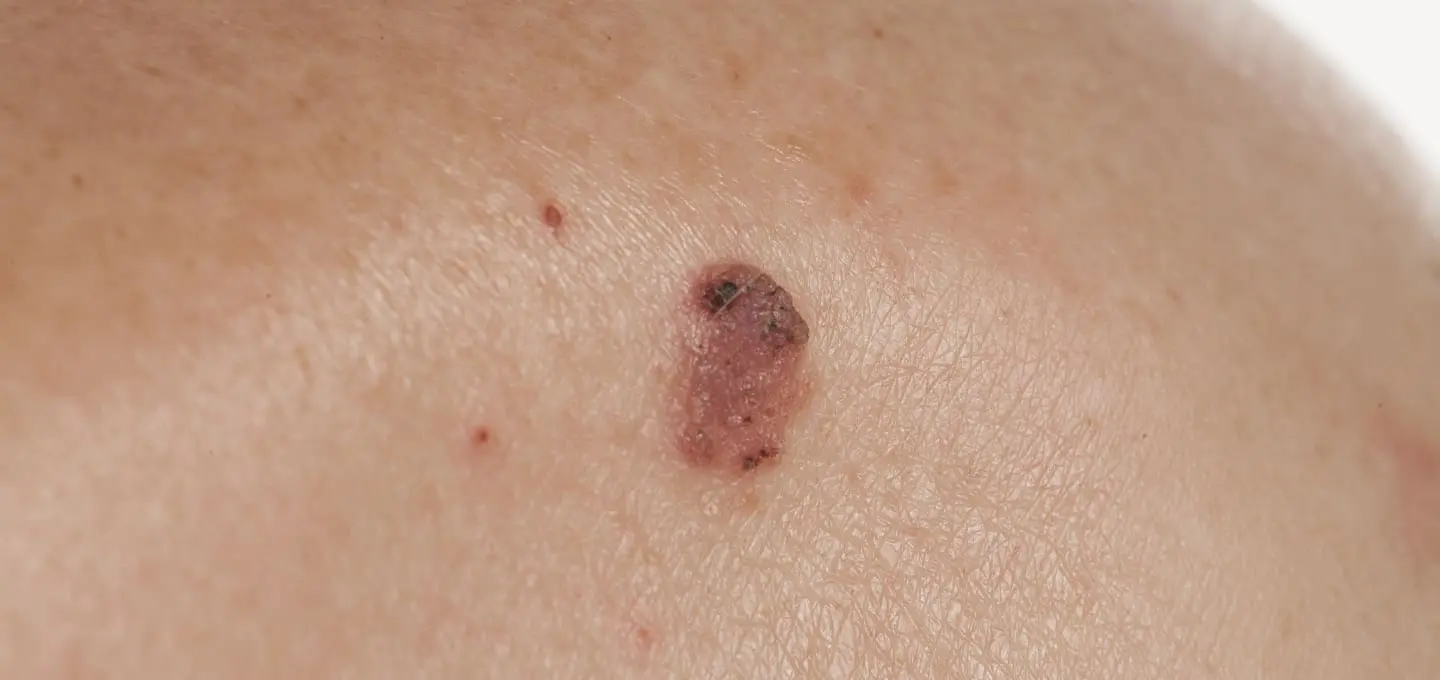 The Day Clinic - Squamous Cell Carcinoma