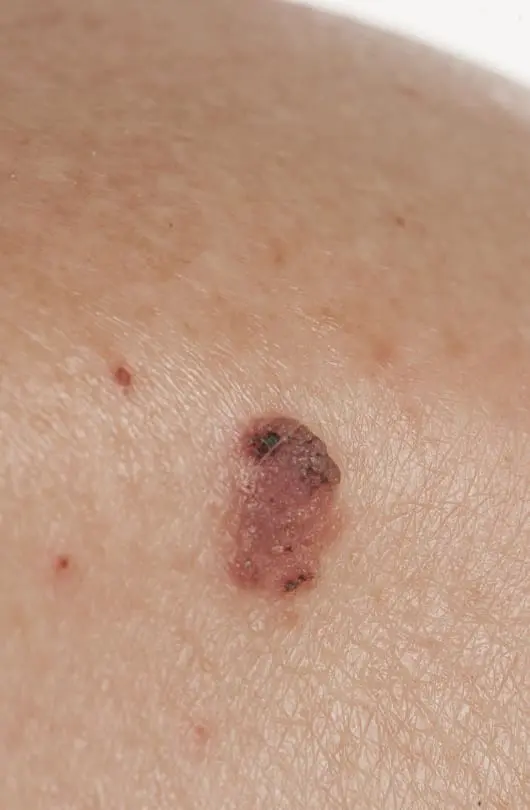 The Day Clinic - Squamous Cell Carcinoma