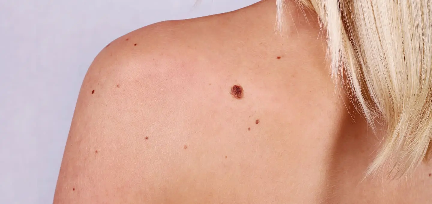 Plastic Surgery Reconstruction After Skin Cancer
