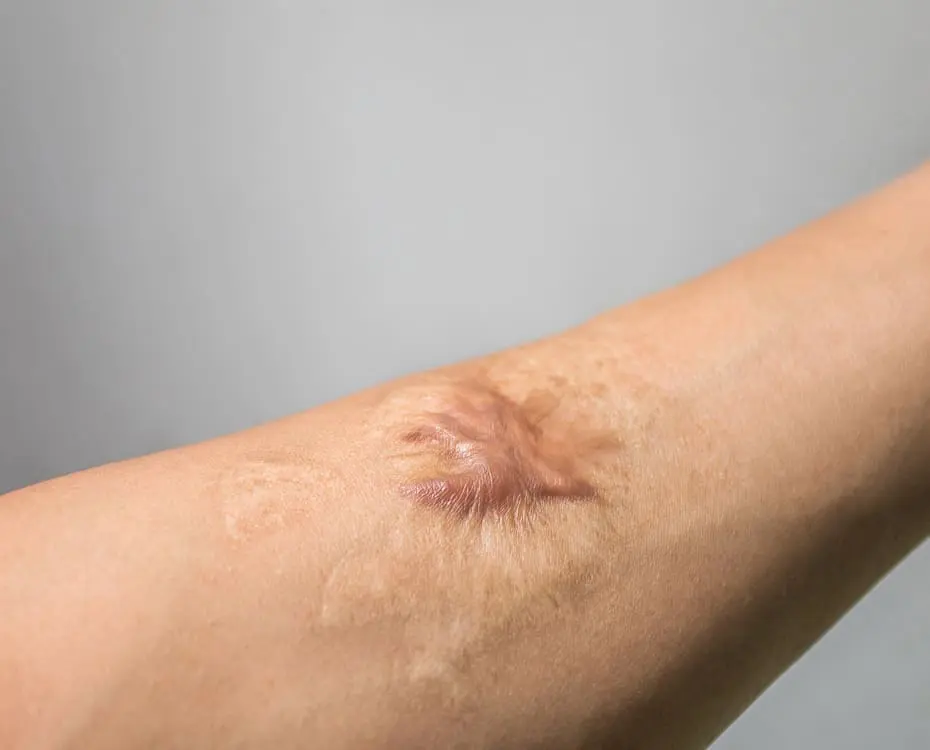 Steroid Injection