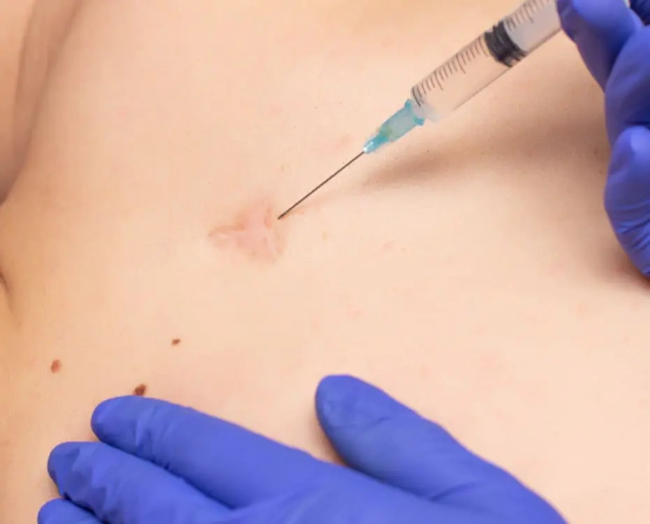 Steroid Injection