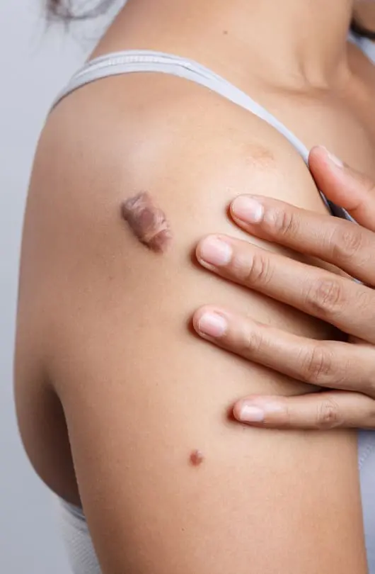 Steroid Injection
