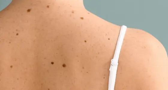 Surgical Excision For Skin Cancer