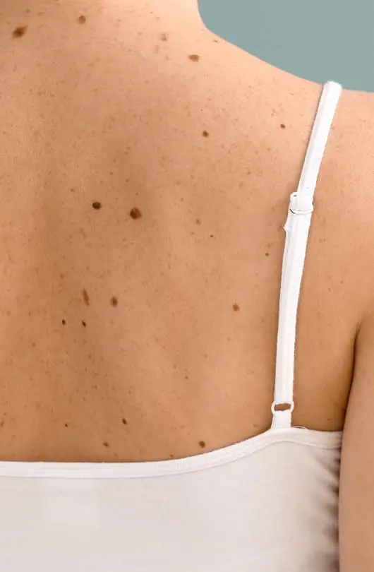 Surgical Excision For Skin Cancer