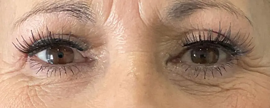 Frontal close-up of patient’s eyes with lifted, smoother upper eyelids after blepharoplasty.