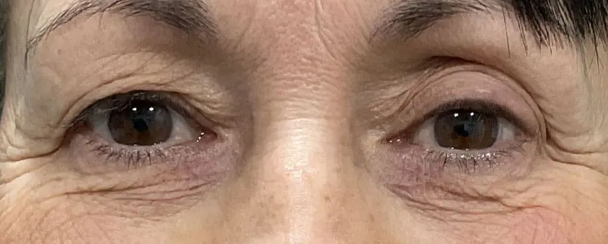 Frontal close-up of patient’s eyes with drooping upper eyelids before blepharoplasty.