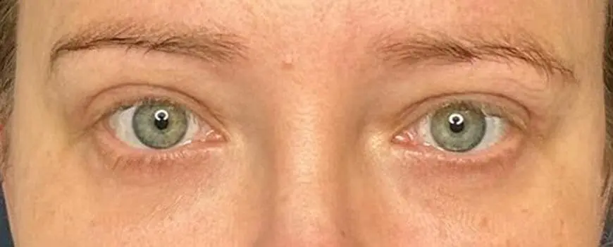 Frontal view of patient’s eyes showing tightened, taut eyelids after blepharoplasty.