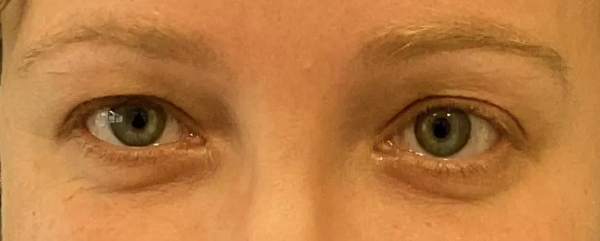 Frontal view of patient’s eyes showing excess bag skin before blepharoplasty.