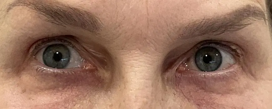 Close-up of patient’s eyes showing reduced upper-eyelid sagging after surgery.