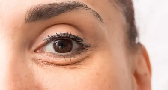 Illustration of eye bags and puffiness - The Day Clinic Cambridge