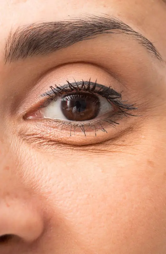 An example of eye bags and eye puffiness - The Day Clinic Cambridge
