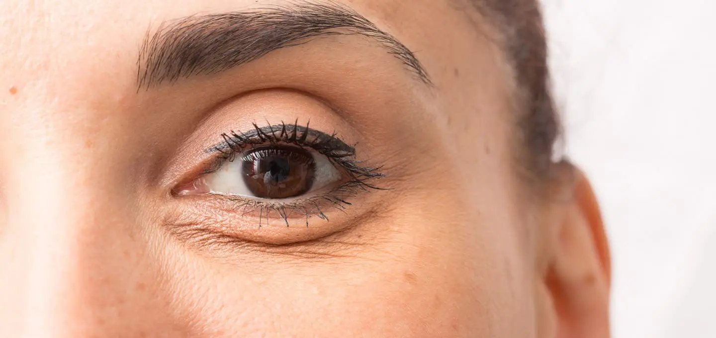 Illustration of eye bags and puffiness - The Day Clinic Cambridge