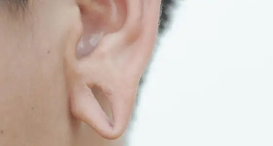 Split Earlobes