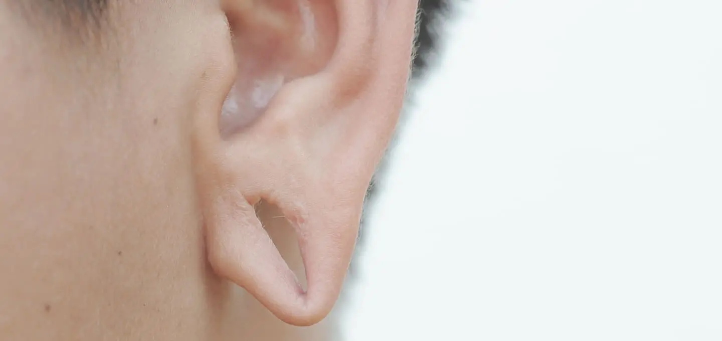 Split Earlobes