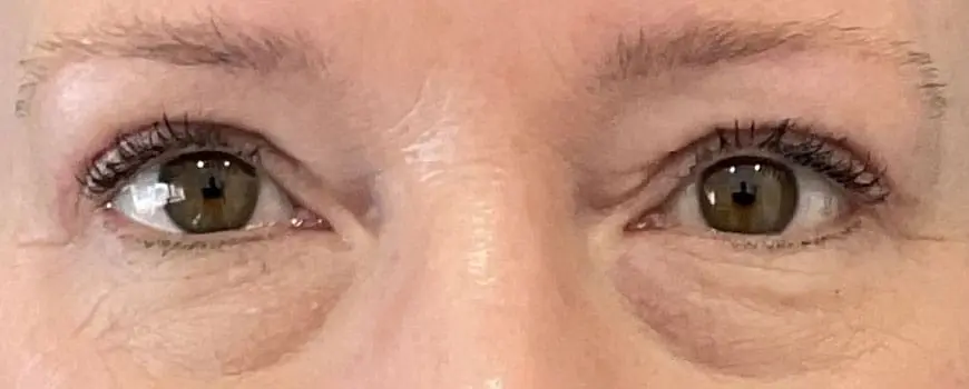 A patient with eye bags removed after blepharoplasty