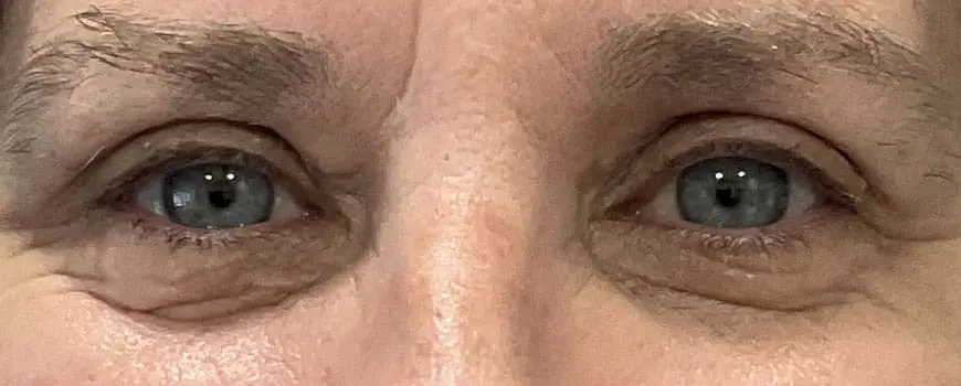 A close up of a patients eyes after blepharoplasty