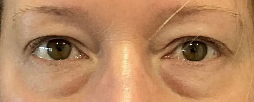 A patient with eye bags before blepharoplasty