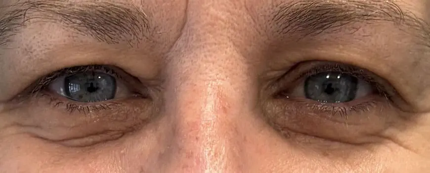 A close up of a patients eyes before blepharoplasty