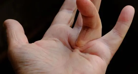 The Day Clinic - Dupuytren’s Contracture