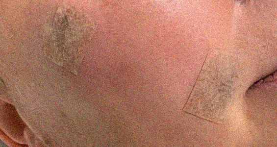 The Day Clinic - Minor Skin Surgery
