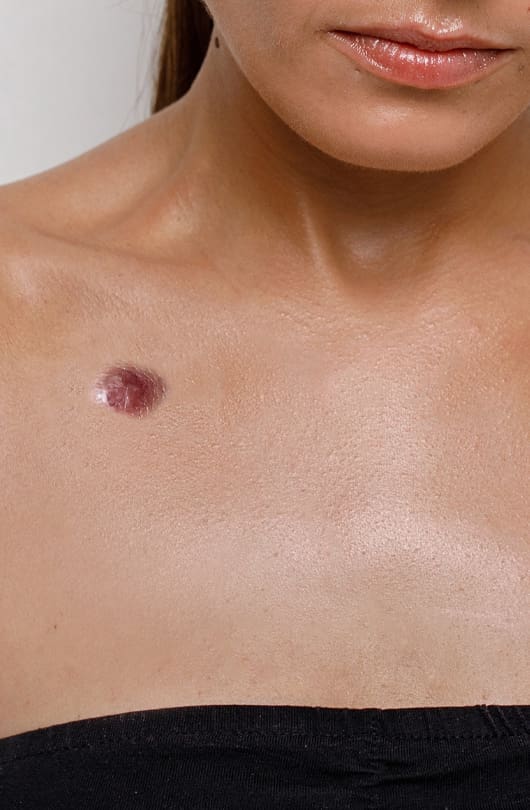 The Day Clinic - Skin Cancer