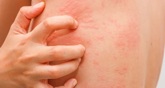 The Day Clinic - Allergies