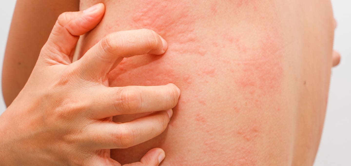 The Day Clinic - Allergies