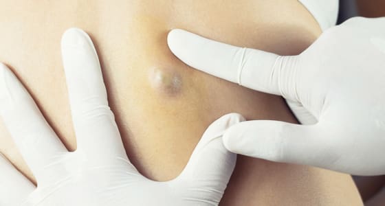 Cysts Treatment Cambridge
