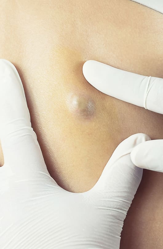 Treating Cysts