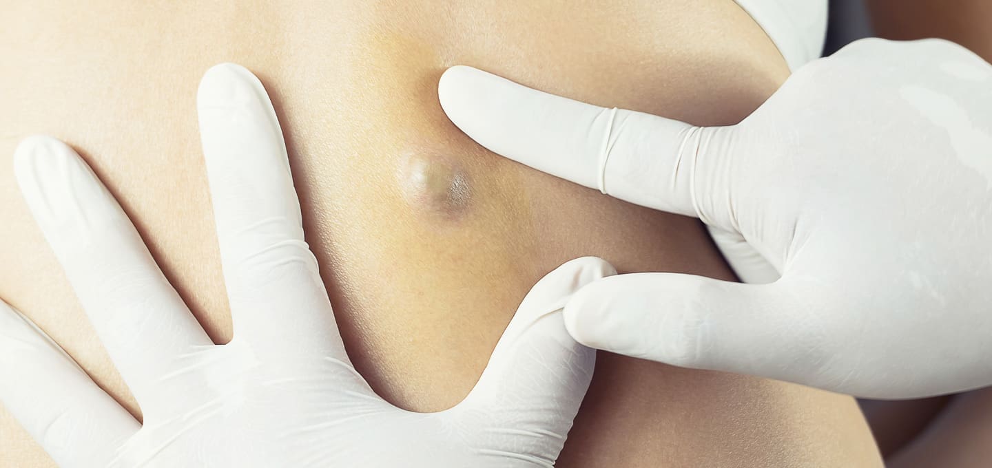 Cysts Treatment Cambridge