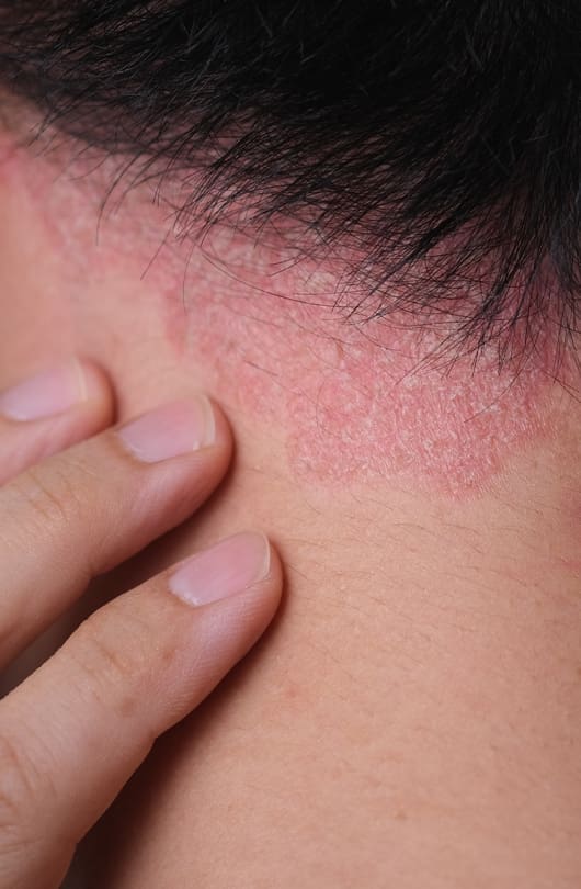 The Day Clinic - Eczema