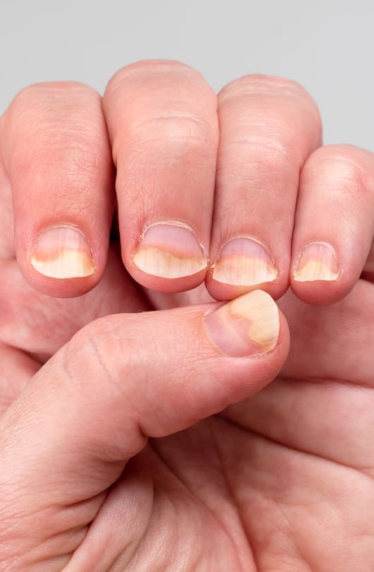 Fungal Infections