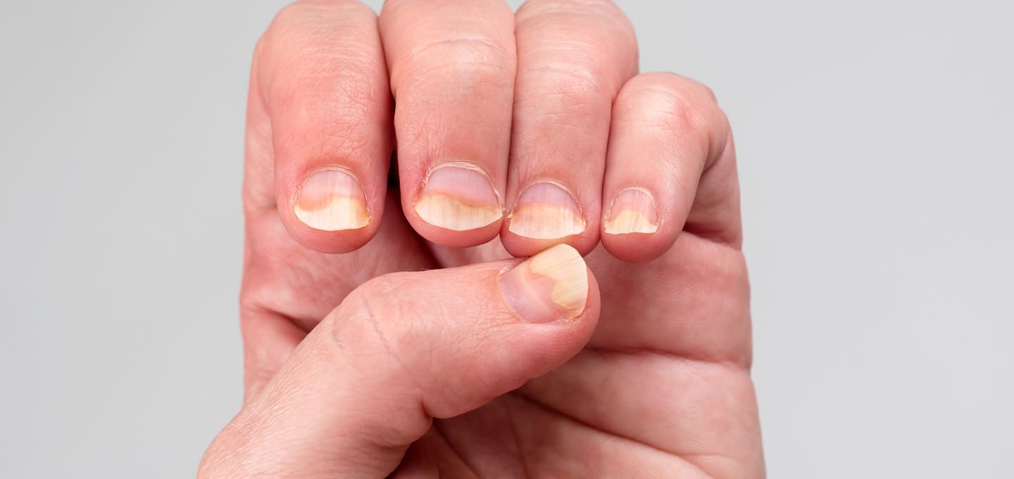 The Day Clinic - Fungal Infections