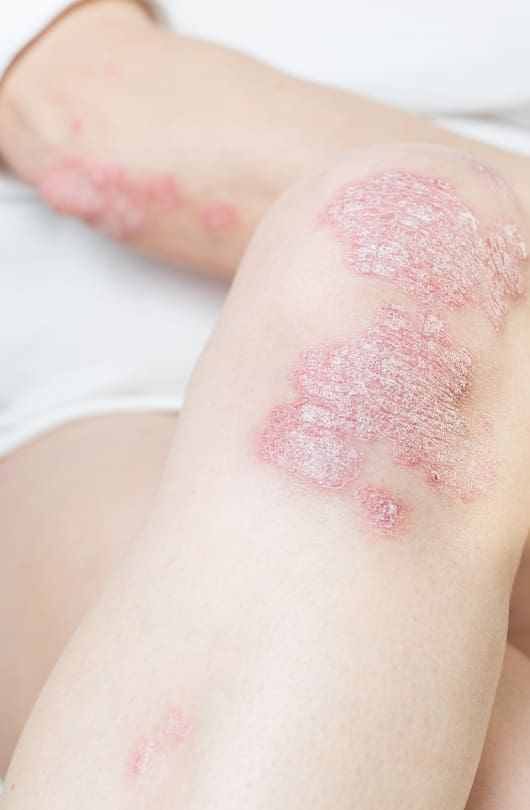 The Day Clinic - Psoriasis